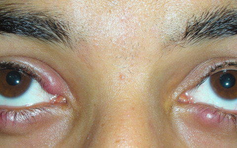 Bolinha no olho: terçol ou calázio? - Hospital de Olhos do Paraná