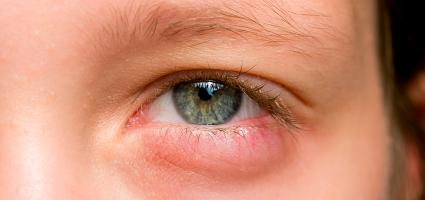 Foto de Closeup Do Olho Olho De Hordéolo Doença Oftalmológica